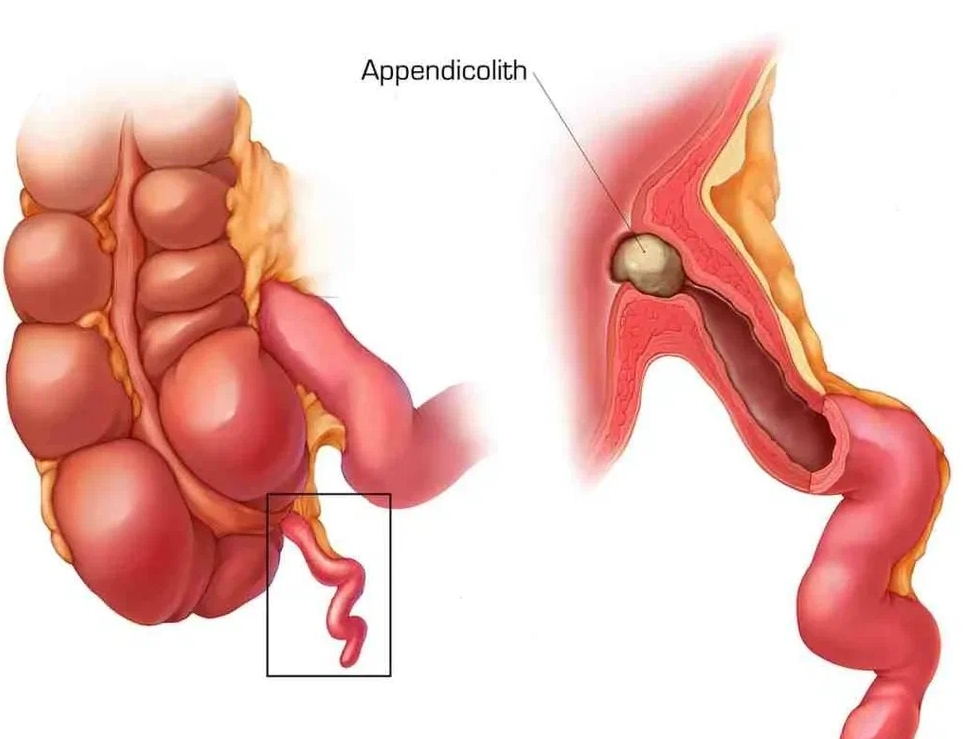 Острый аппендицит картинки для презентации